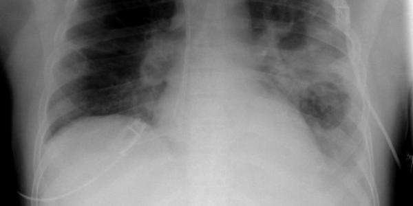 659px-xr_chest_-_pneumonia_with_abscess_and_caverns_-_d0