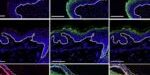 20161004_Ciruela_psoriasis1 20161004_Ciruela_psoriasis1
