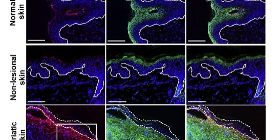 20161004_Ciruela_psoriasis1