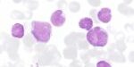 20170329_esteller_leukemia 20170329_esteller_leukemia