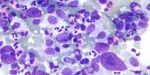 Hodgkin_lymphoma_cytology_large