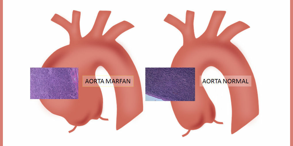 Marfan-GEgea