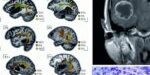 NO016 - Bruna_Neuro-oncology NO016 - Bruna_Neuro-oncology