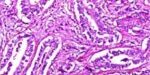 cancer_colon cancer_colon