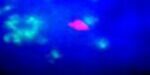cancer_pulmo (1)