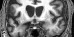 cervell_huntington cervell_huntington