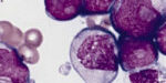 leucemia