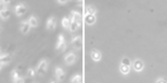 limfoma_cells