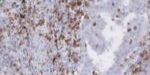 lung_cacner lung_cacner