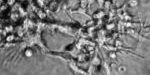 melanoma