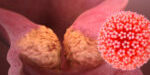 np13_-_hpv_lalemany_jnci_-_image_virus np13_-_hpv_lalemany_jnci_-_image_virus