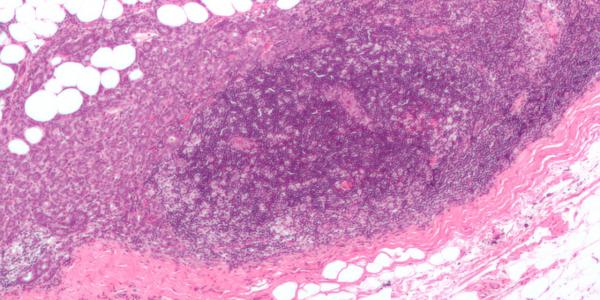 breast_carcinoma_in_a_lymph_node