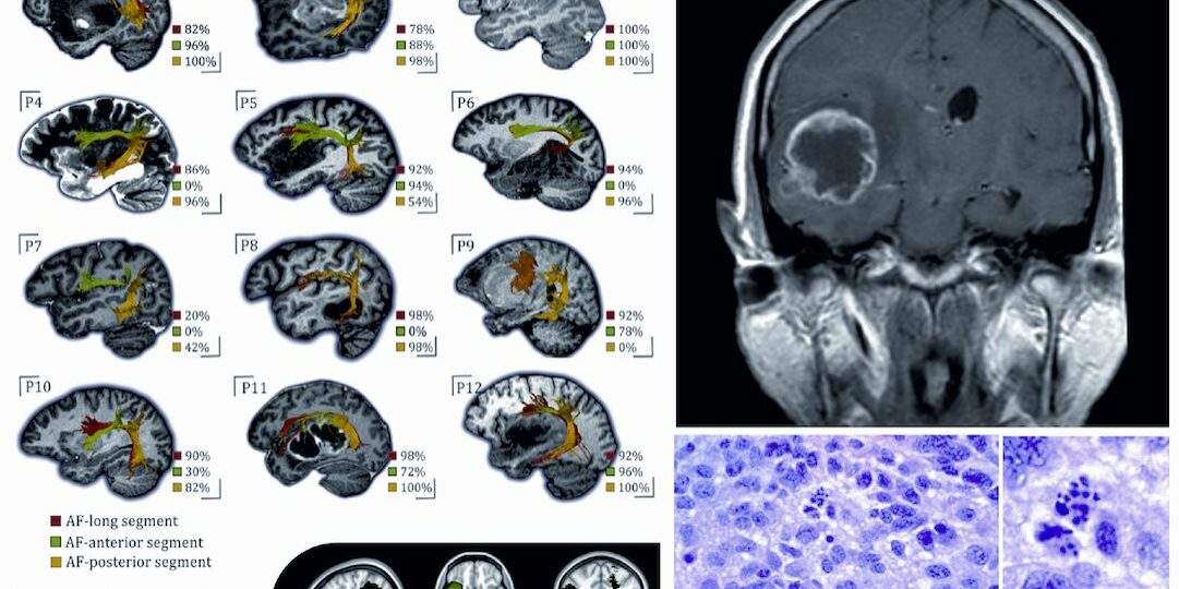 NO016 - Bruna_Neuro-oncology