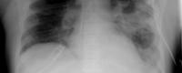 659px-xr_chest_-_pneumonia_with_abscess_and_caverns_-_d0