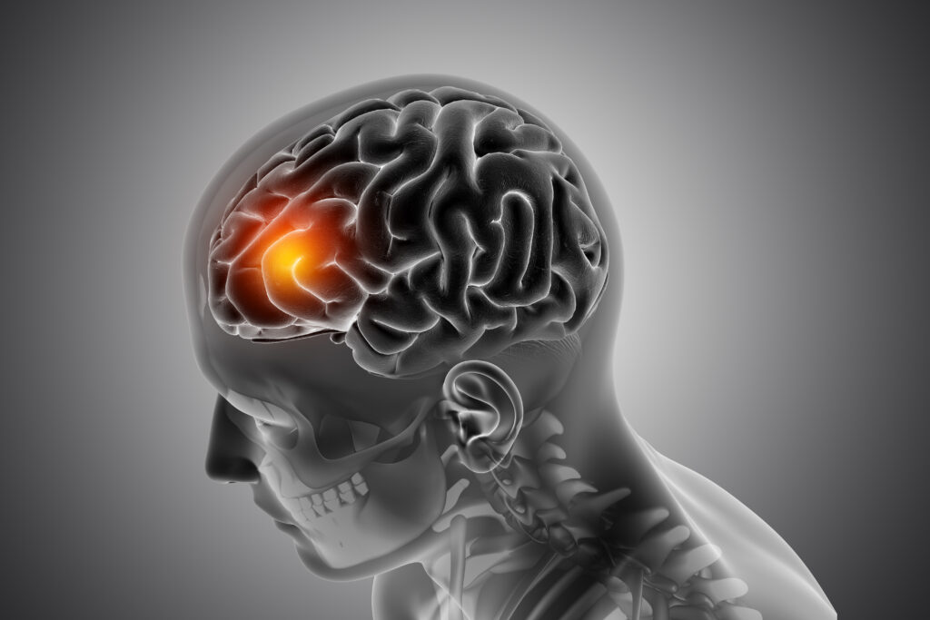 3D render of a male medical figure with front of the brain highlighted