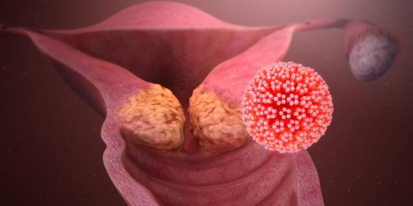 hpv_causing_cervical_cancer