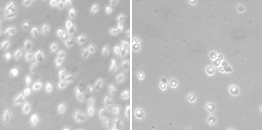 limfoma_cells